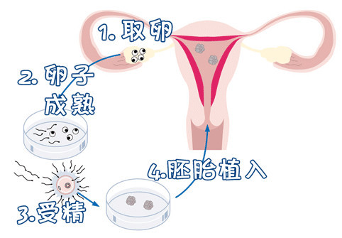 三代供卵试管选性别包生男孩